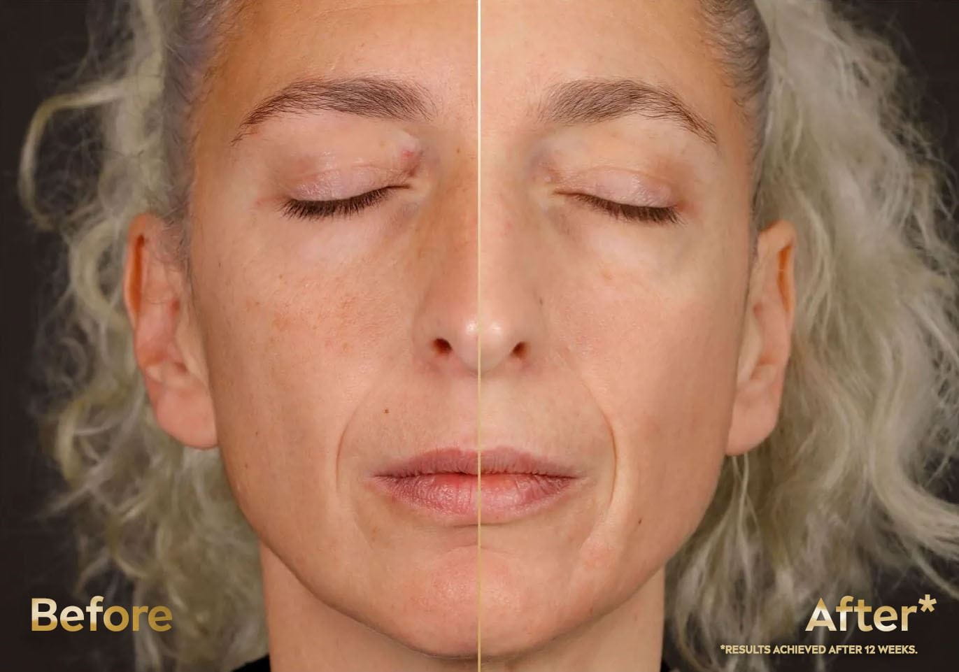 Before and after Nivea Luminous 630 on an elderly white-skinned woman, showing reduced dark spots, sun spots, age spots, and post-acne marks after 4 weeks.