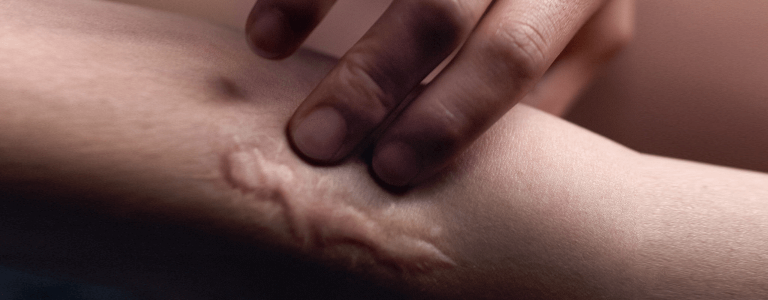Cicatriz en la piel de una persona