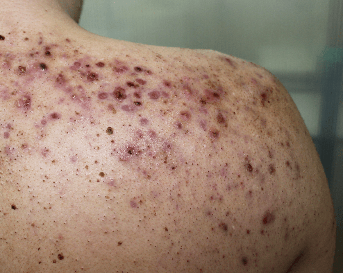 Persona con acné en la espalda