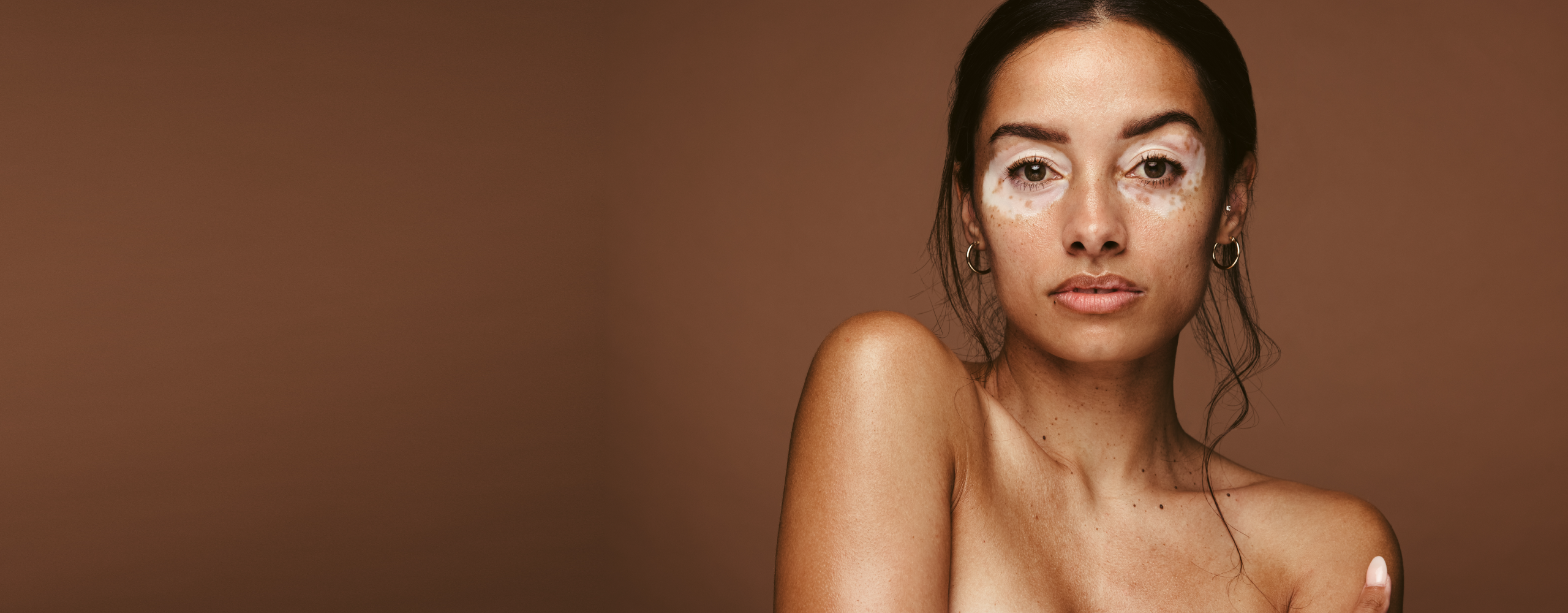 Persona con vitiligo en la piel