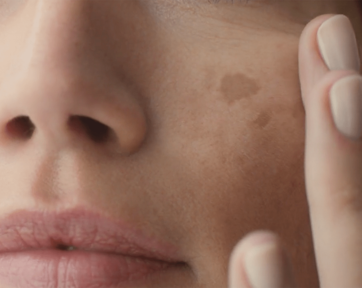 Persona con manchas en la piel del rostro