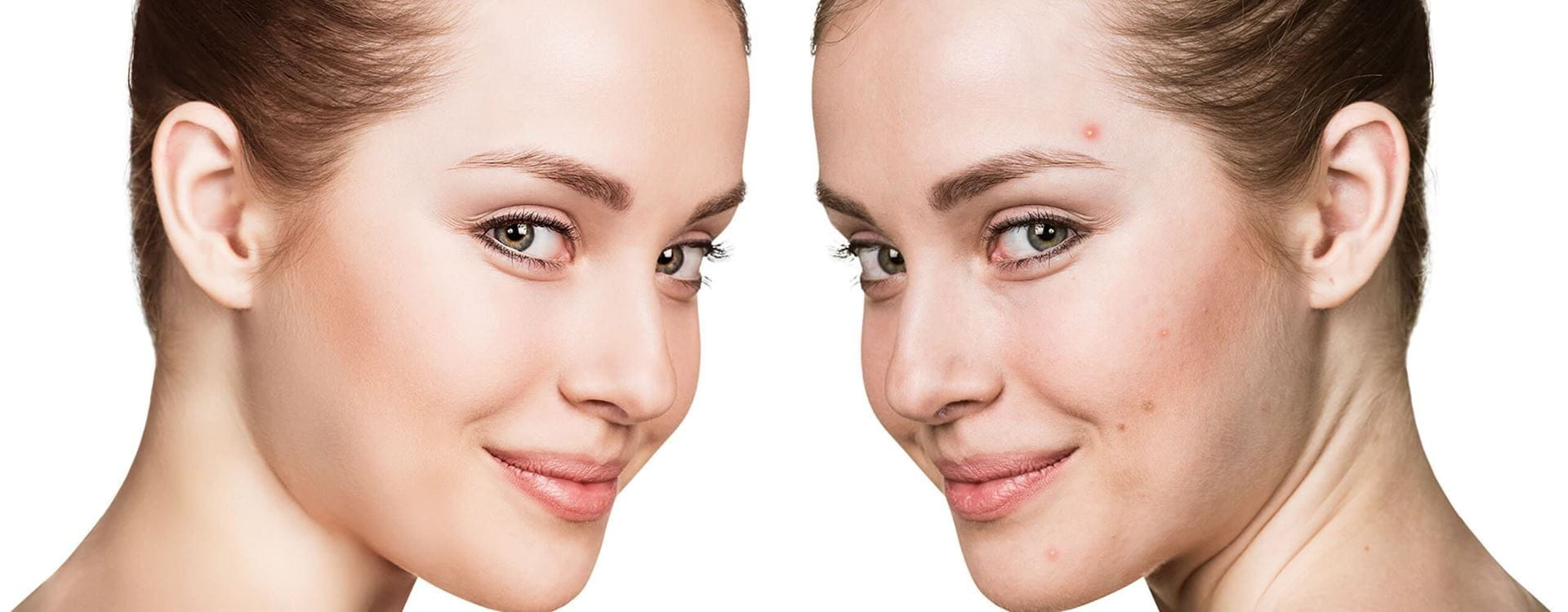  ¿Cómo se originan y cómo se eliminan las manchas de acné?
