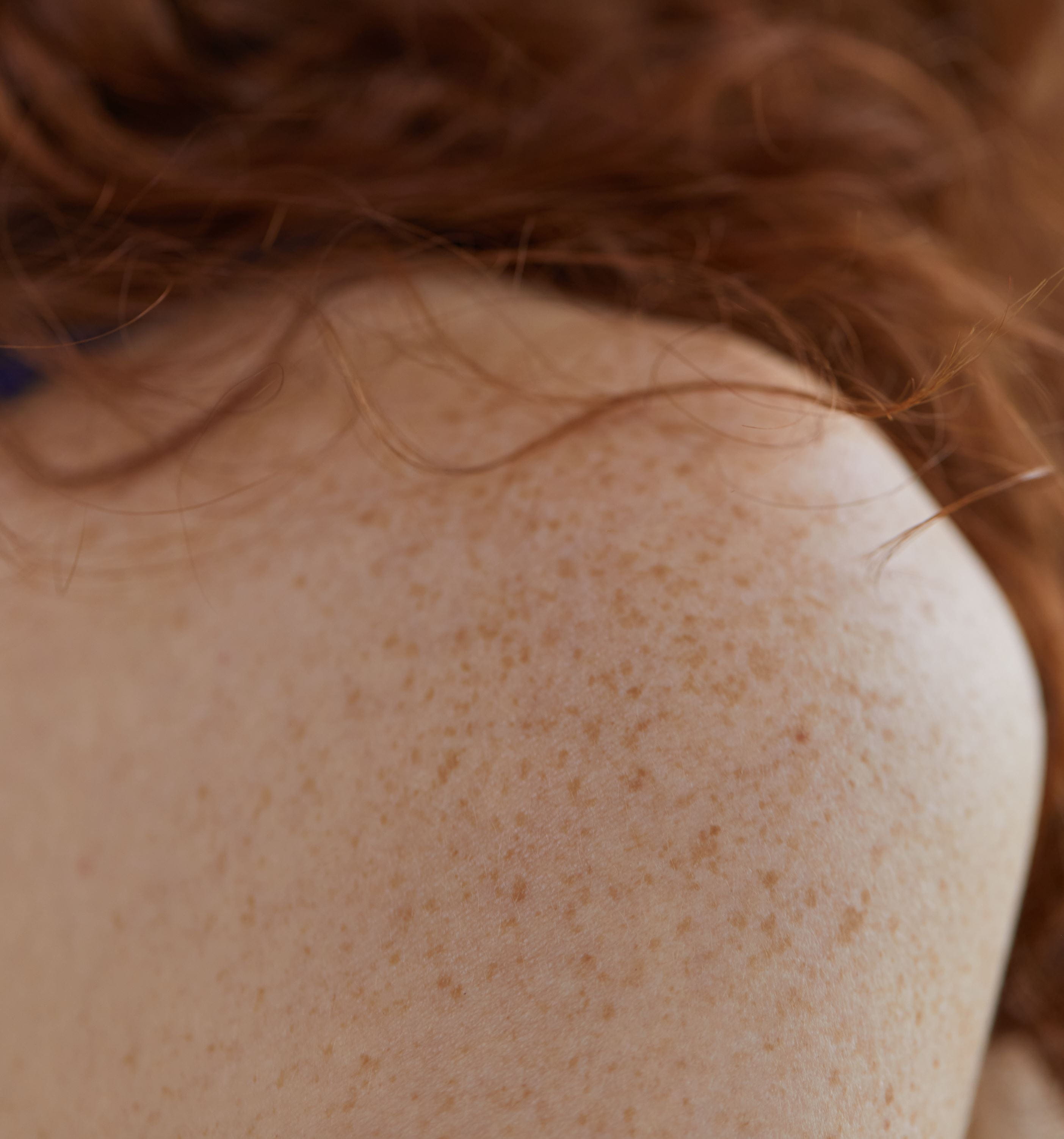 woman with freckles on her back