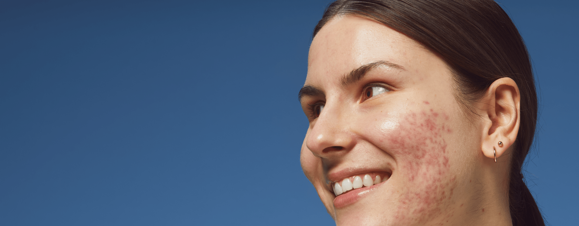 woman with acne smiling