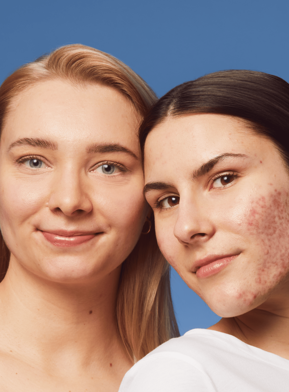 one girl with clear skin & one with acne