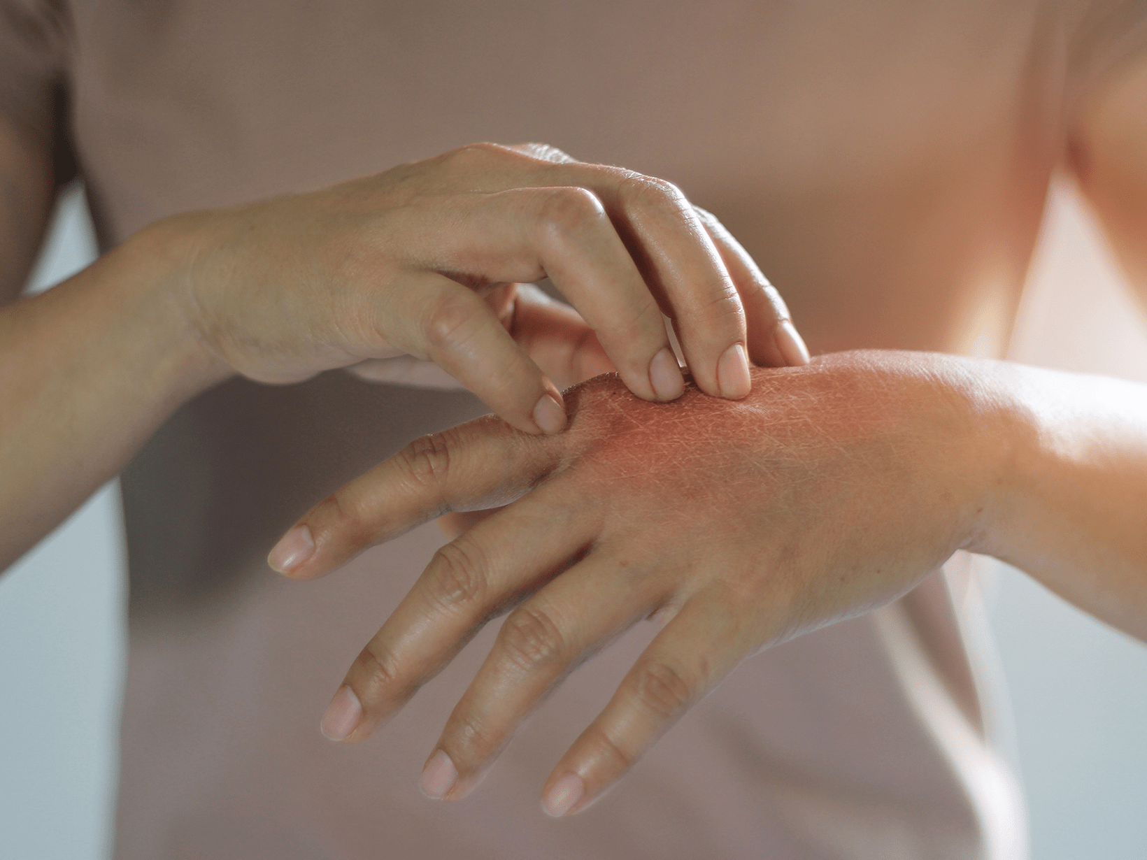 La dermatite da contatto può causare prurito alle mani