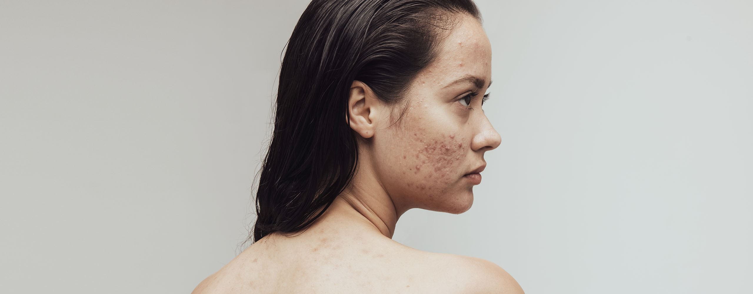 LAS MANCHAS DE ACNE Y SU TRATAMIENTO NIVEA