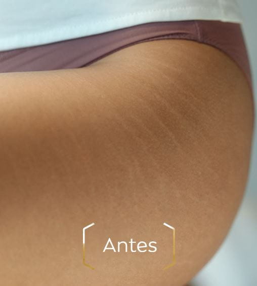 Piel con estrías sin usar Nivea®