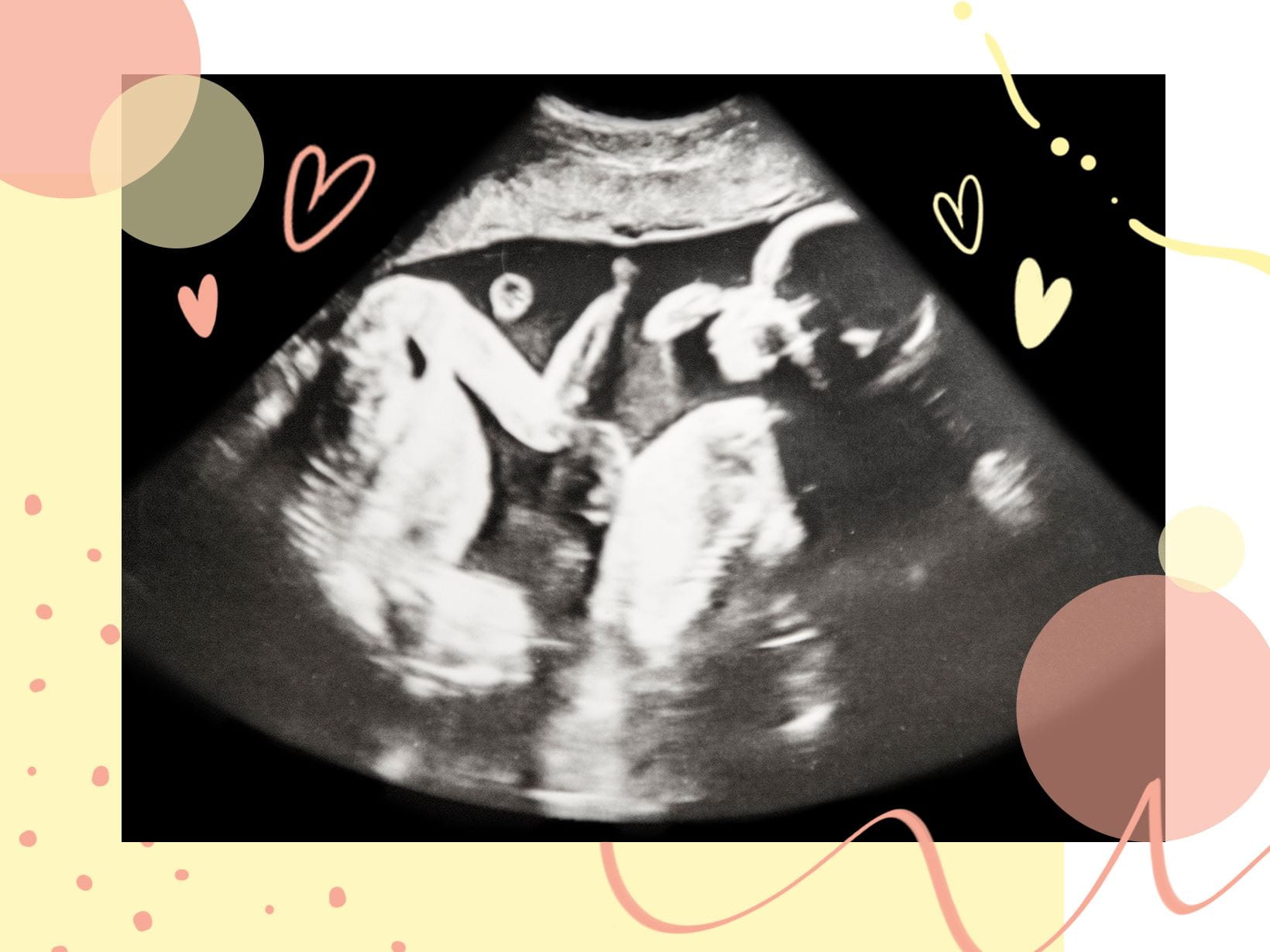 Ciąża bliźniacza jednojajowa a dwujajowa