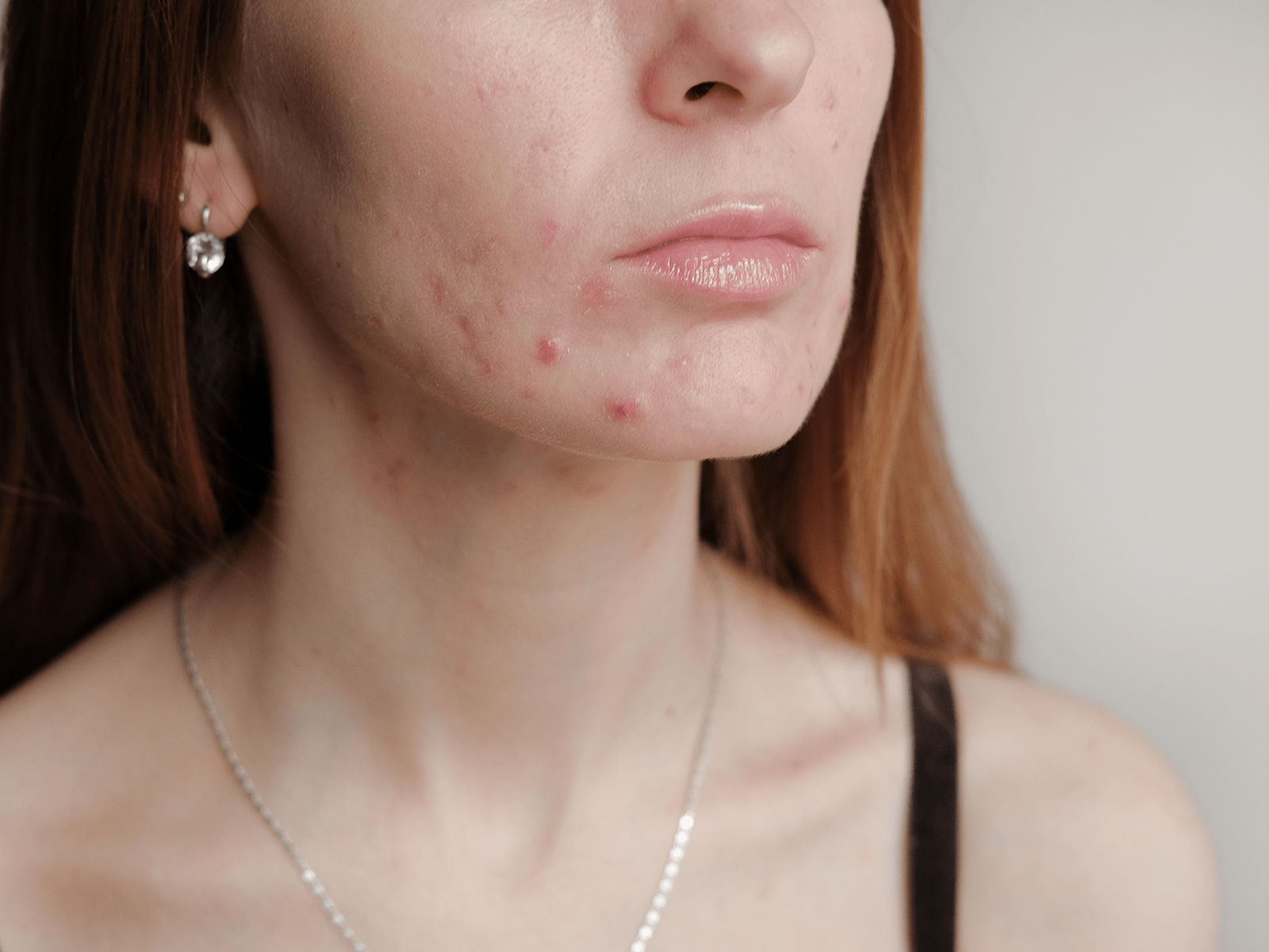 mulher com dermatite provocada pelo uso de máscara