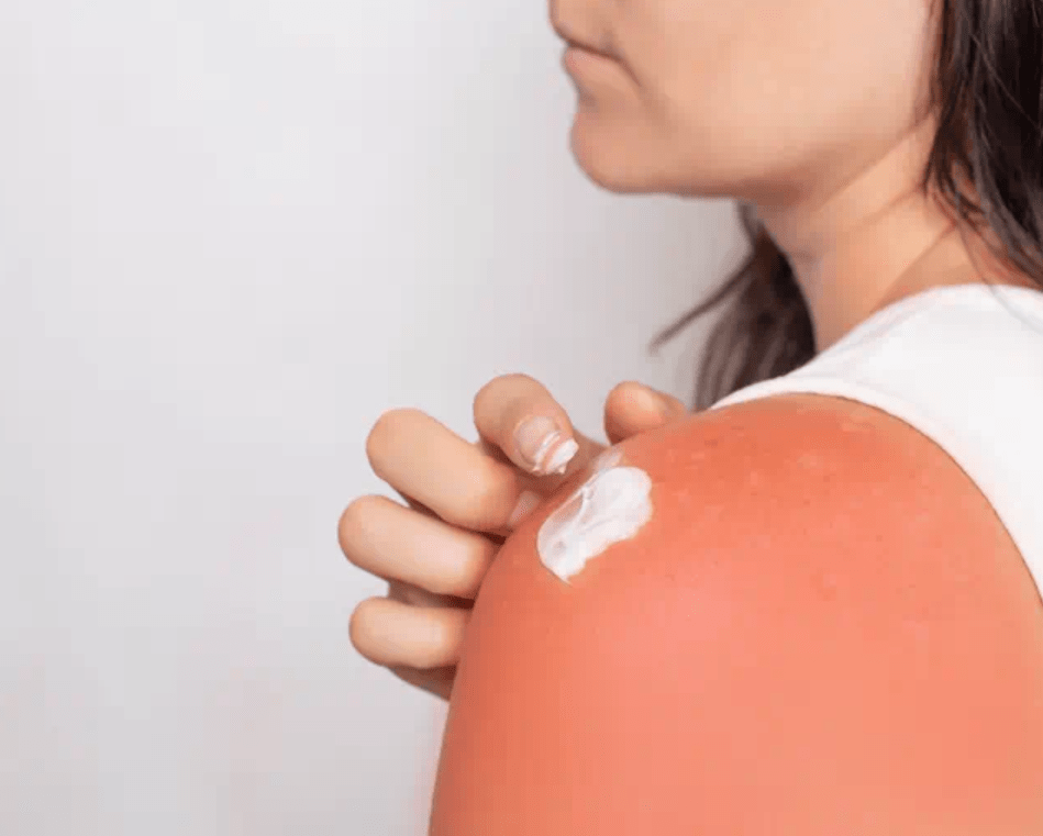 Mulher a aplicar creme reparador no ombro com queimadura
