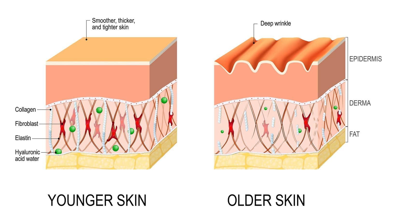 types of wrinkles